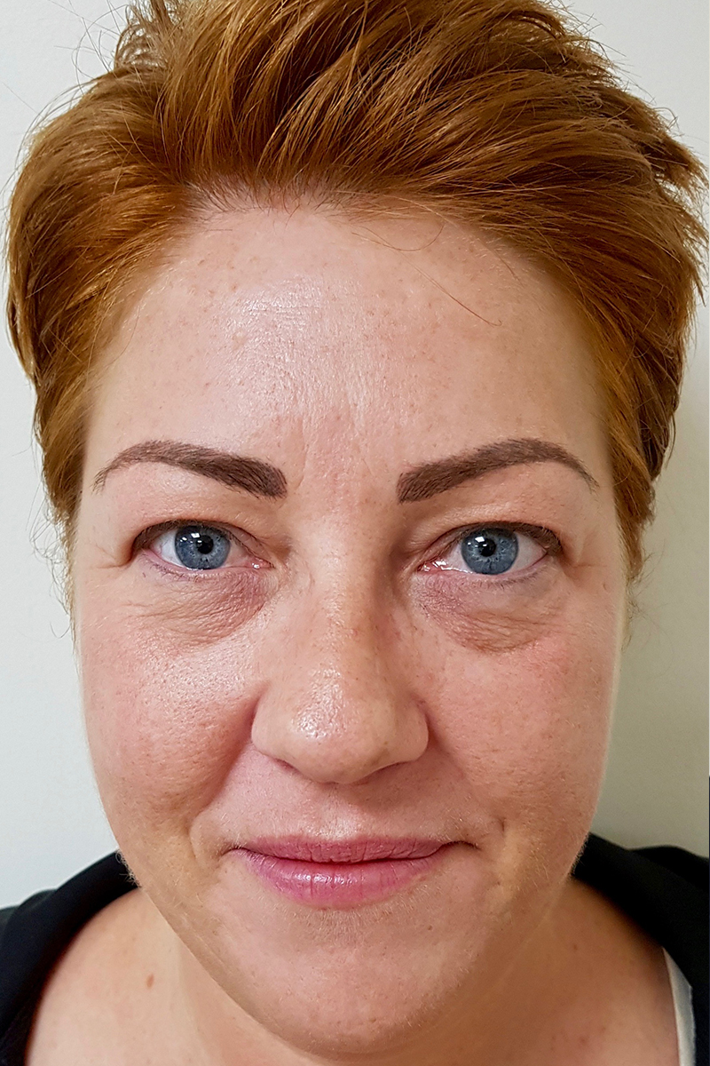 Before & After — before (pre-operative)